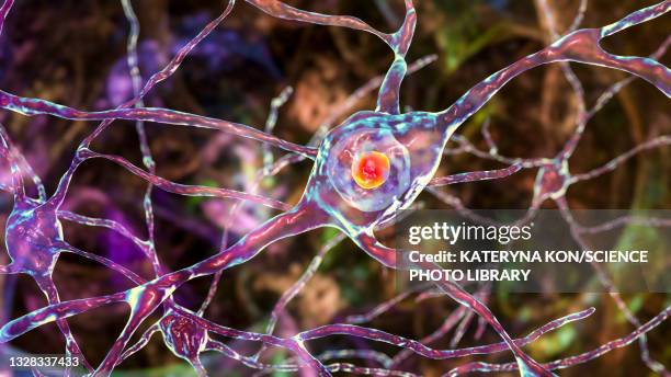 stockillustraties, clipart, cartoons en iconen met neuronal inclusions in huntington's disease, illustration - neuropathy