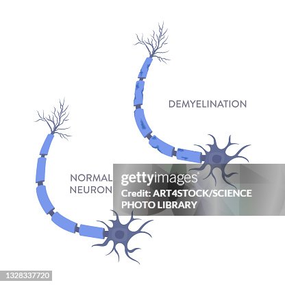 Demyelination, illustration Demyelination, illustration