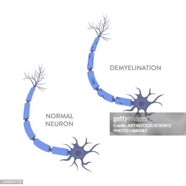 demyelination, illustration - neuroscience stock illustrations