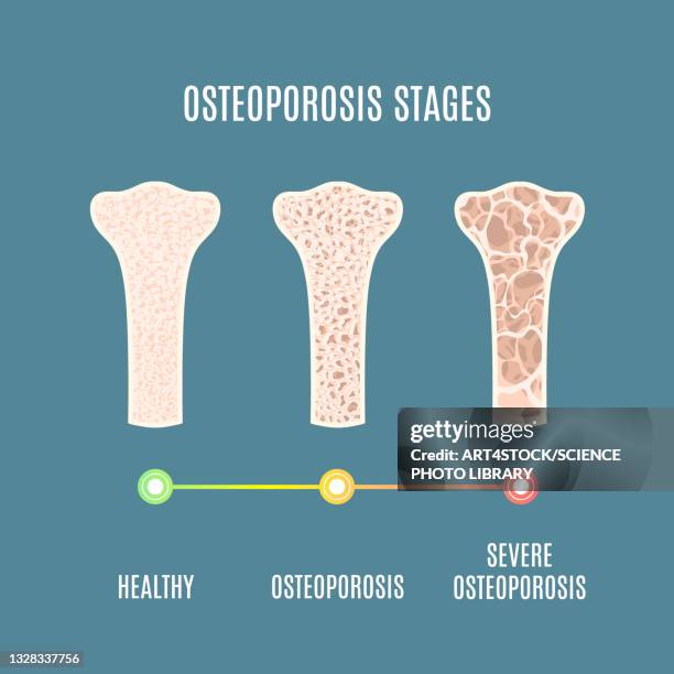 ilustraciones, imágenes clip art, dibujos animados e iconos de stock de osteoporosis, illustration - osteoporosis