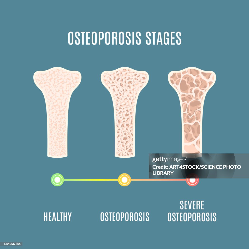 Osteoporosis, illustration