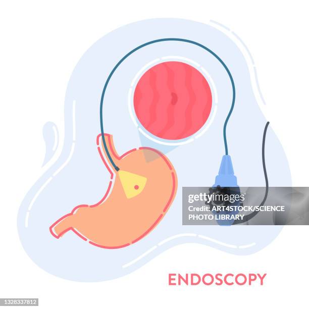 ilustraciones, imágenes clip art, dibujos animados e iconos de stock de endoscopy, conceptual illustration - ulcer