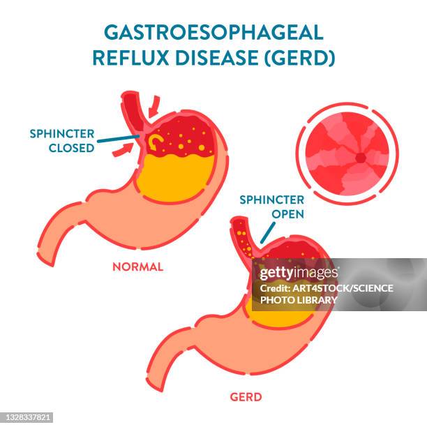 gastroesophageal reflux disease, illustration - 内視鏡点のイラスト素材／クリップアート素材／マンガ素材／アイコン素材