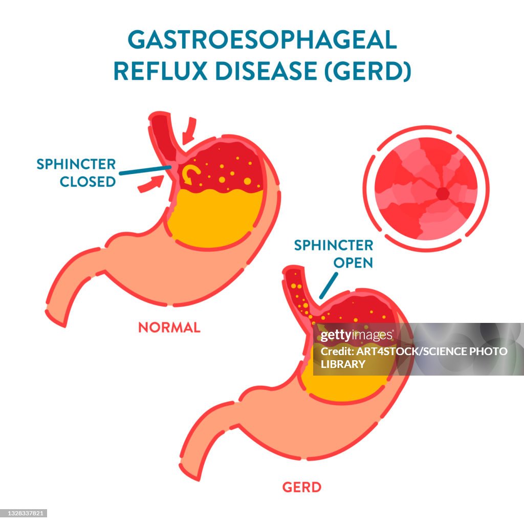 Acid Reflux Problem Gastroesophageal Reflux Disease Illustration High-Res Vector Graphic ...