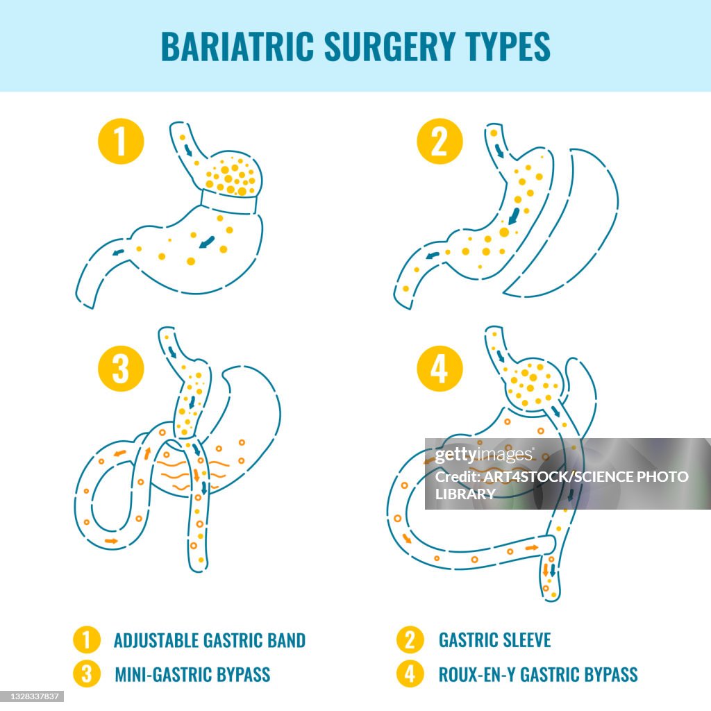 Bariatric surgery types, illustration