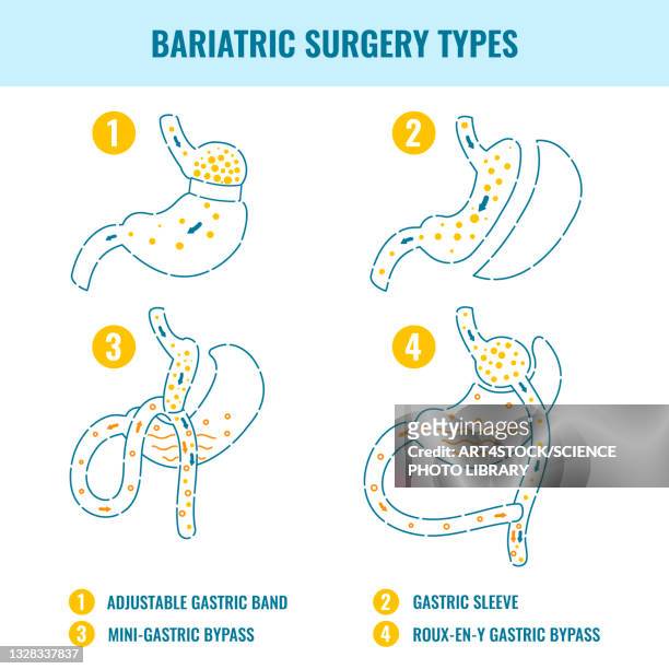 bariatric surgery types, illustration - abdomen diagram stock illustrations