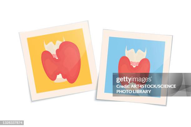 illustrazioni stock, clip art, cartoni animati e icone di tendenza di hyperthyroidism and healthy thyroid gland, illustration - diencephalon