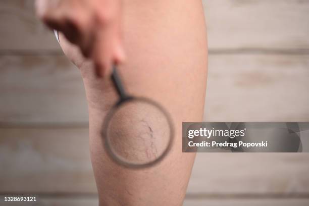 human veins and skin under magnifying glass - varicose vein stock pictures, royalty-free photos & images