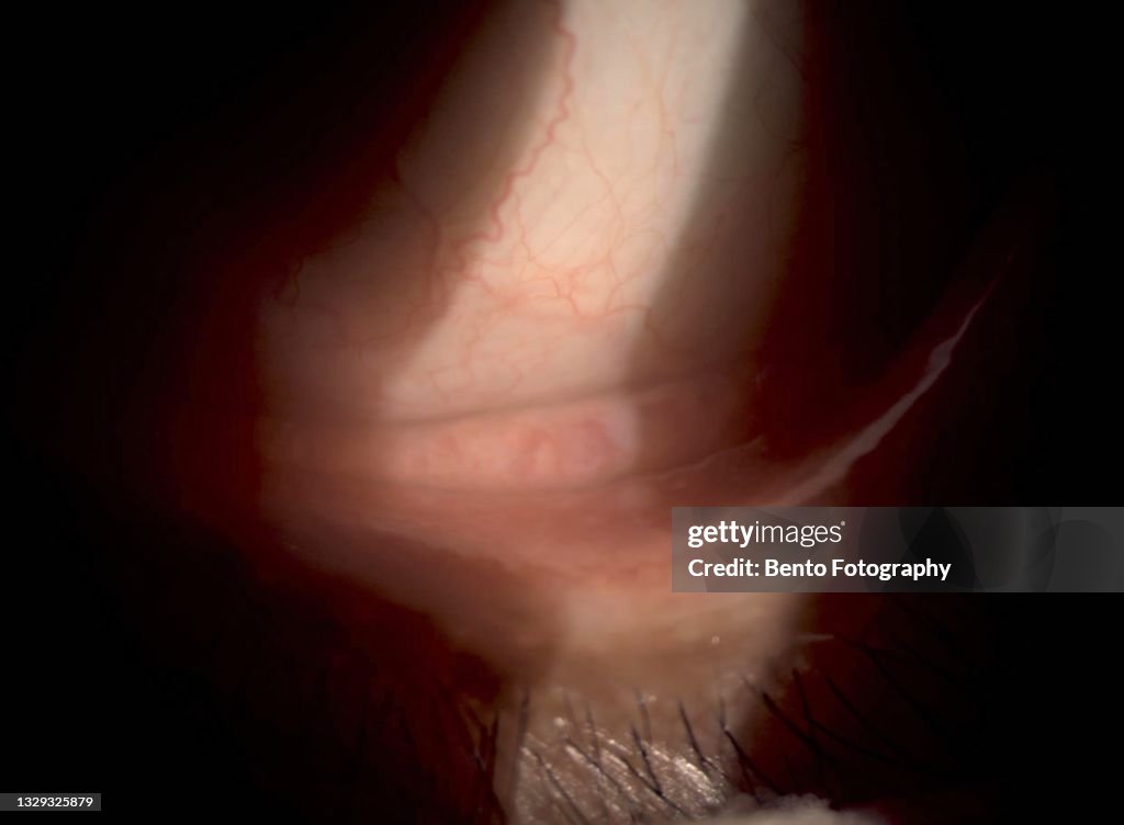 Close up photo of eye with follicular reaction at bulbar conjunctiva