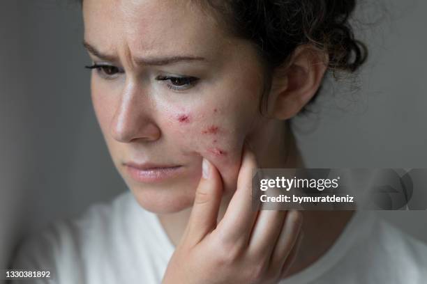 junge frau hat probleme mit haut im gesicht - haut pickel stock-fotos und bilder