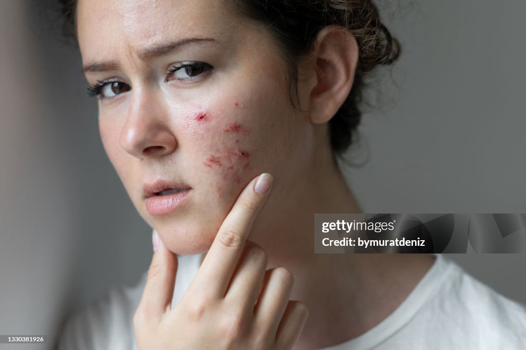 Face With Problem Young Woman Has Problems With Skin On The Face High-Res Stock Photo ...