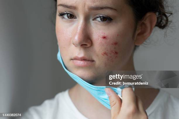 portrait of woman looking for acne - protective face mask bildbanksfoton och bilder