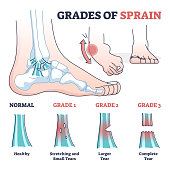 Grades of sprain as ankle or foot medical injury levels outline diagram