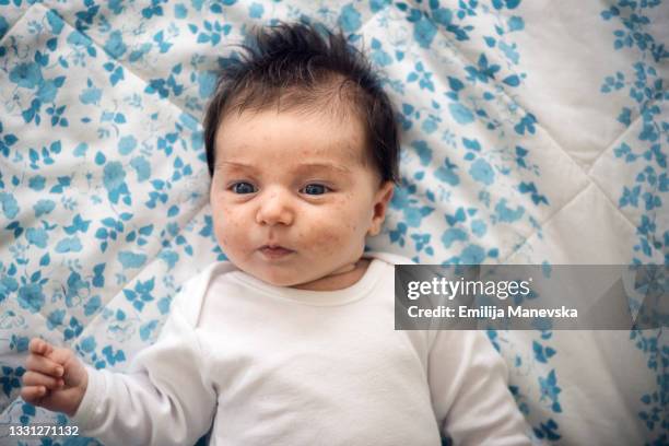portrait of problematic baby face skin. baby acne - dermatitis stock pictures, royalty-free photos & images
