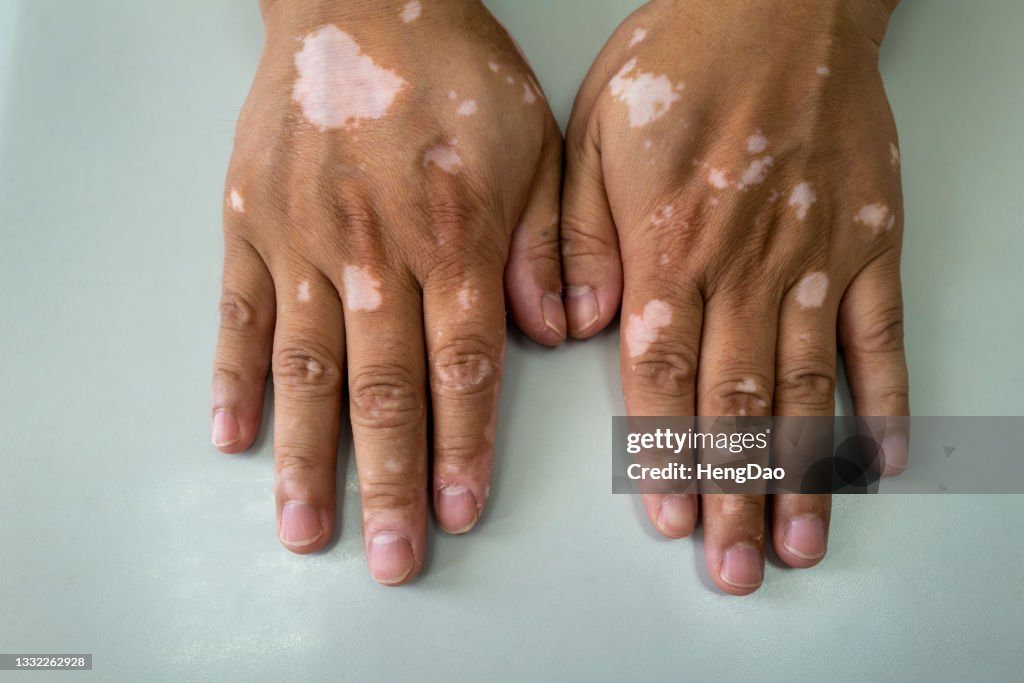 Hand Vitiligo