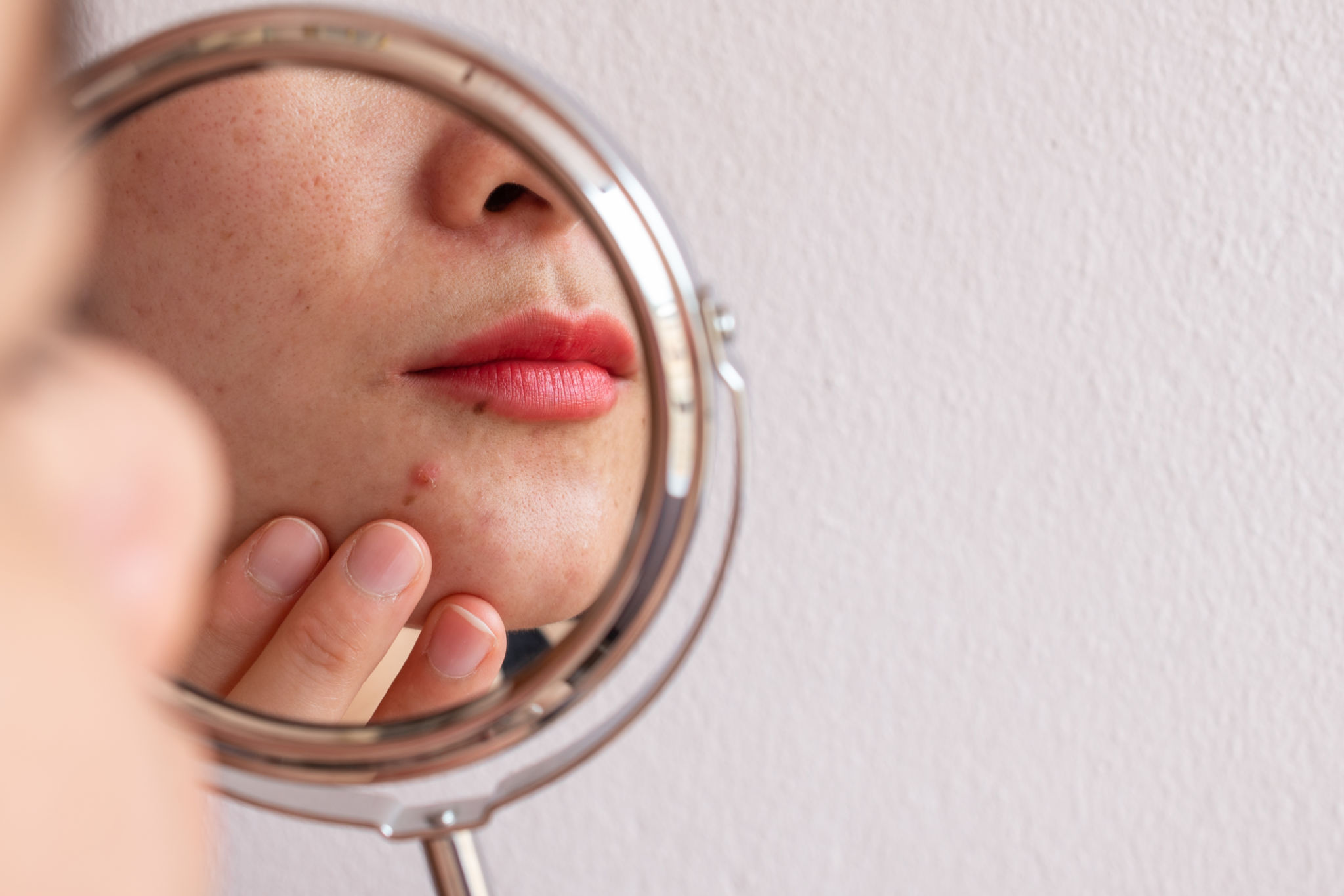 adult acne