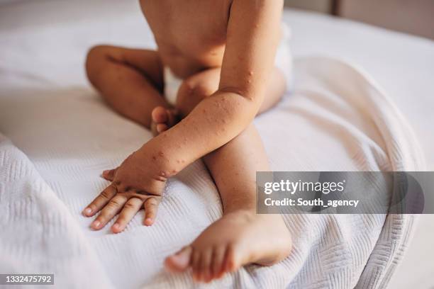 child with with hand foot and mouth disease - chickenpox stock pictures, royalty-free photos & images