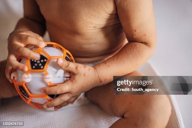 kind mit hand-maul- und klauenseuche - enterovirus stock-fotos und bilder