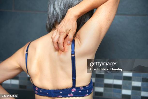 woman with shingles - huidaandoening stockfoto's en -beelden