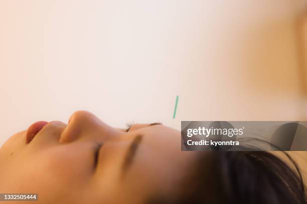 facial cosmetic acupuncture for female in asia - acupuncture needle stock pictures, royalty-free photos & images