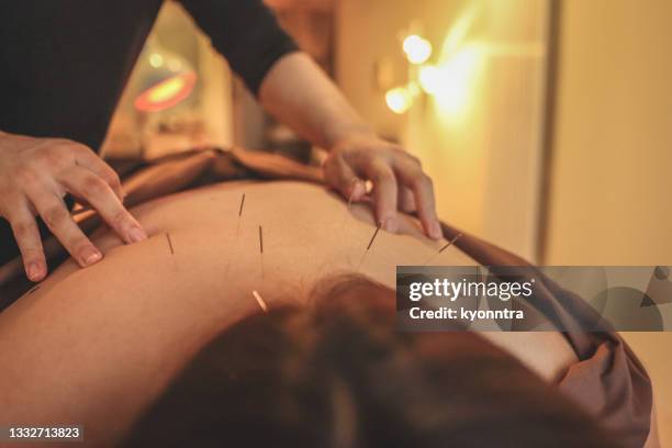 nahaufnahme der körperakupunktur als alternativmedizin - acupuncture stock-fotos und bilder