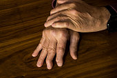 The hands of a male with Psoriatic Arthritis