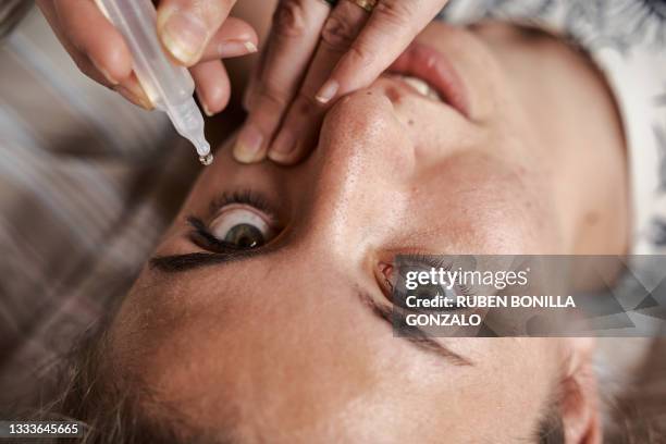 ophthalmologist pouring eye drops in the eye of a caucasian adolescence patient with conjunctivitis. - eyedropper bildbanksfoton och bilder