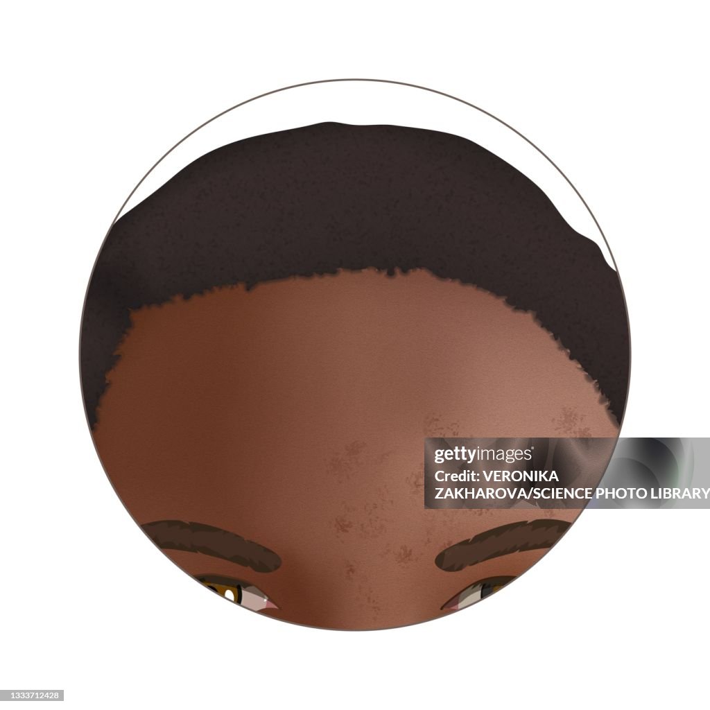 Post-inflammatory hyperpigmentation, illustration