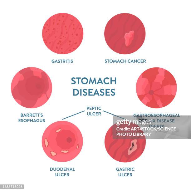 stomach diseases, illustration - 内視鏡点のイラスト素材／クリップアート素材／マンガ素材／アイコン素材