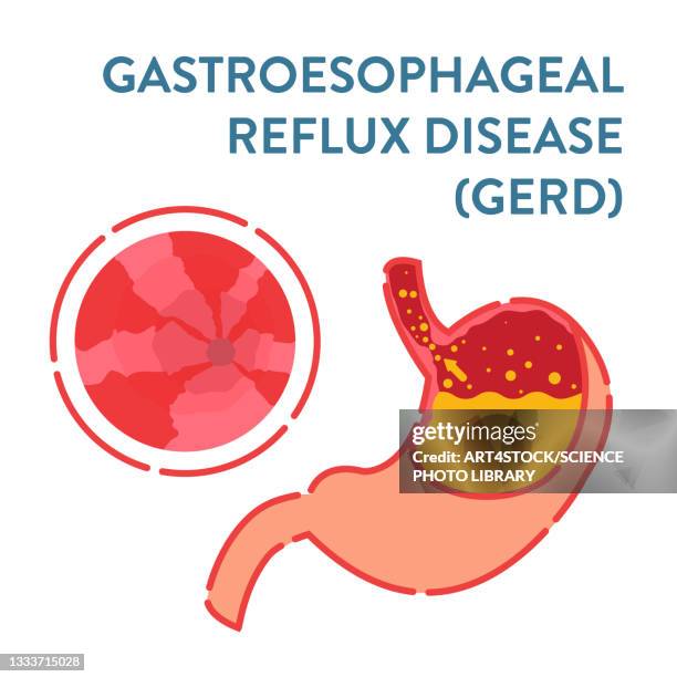 gastroesophageal reflux disease, illustration - heartburn stock illustrations