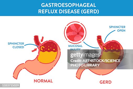 Gerdft Gastroesophageal Reflux Disease Illustration High-Res Vector Graphic ...