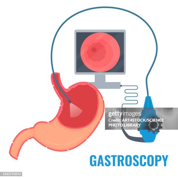 gastroscopy, conceptual illustration - 内視鏡点のイラスト素材／クリップアート素材／マンガ素材／アイコン素材