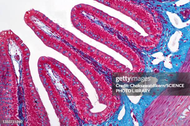 colon biopsy, light micrograph - colon cancer stock pictures, royalty-free photos & images