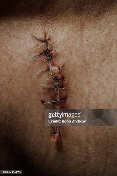 surgical suture. - cicatriz imagens e fotografias de stock