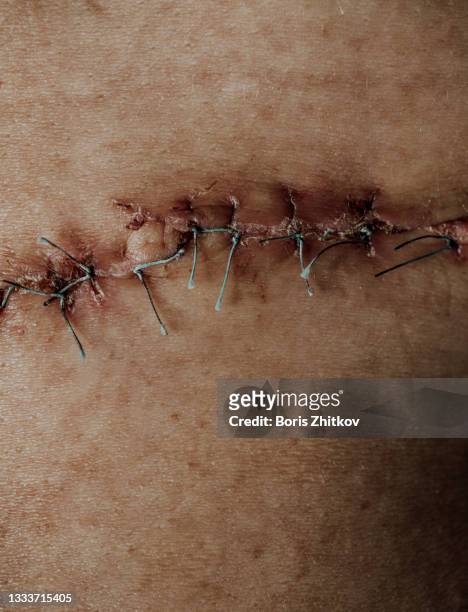 surgical suture. - cicatriz imagens e fotografias de stock