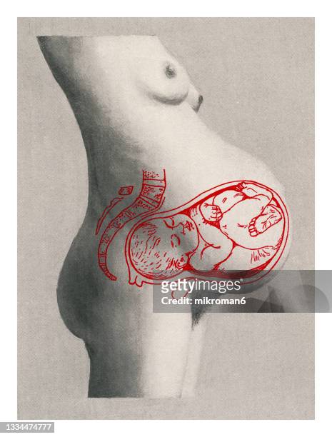 old engraved illustration of position of the child and uterus in a case of pendulous abdomen - anatomy illustration stock pictures, royalty-free photos & images