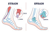 Sprain vs strain anatomical comparison as medical foot injury outline diagram