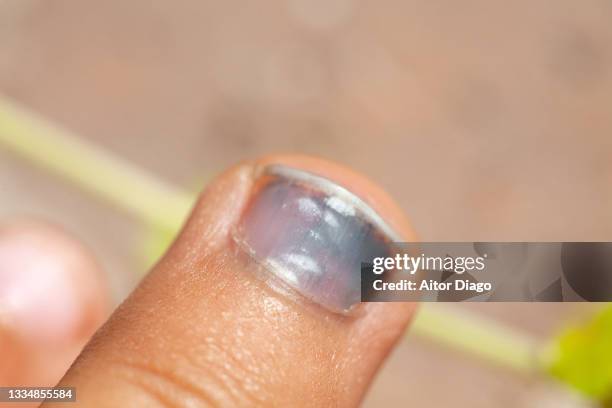 close-up of a finger of an unrecognizable person (child) damaged by a strong blow. the fingernail is purple.. - bruised finger stock-fotos und bilder