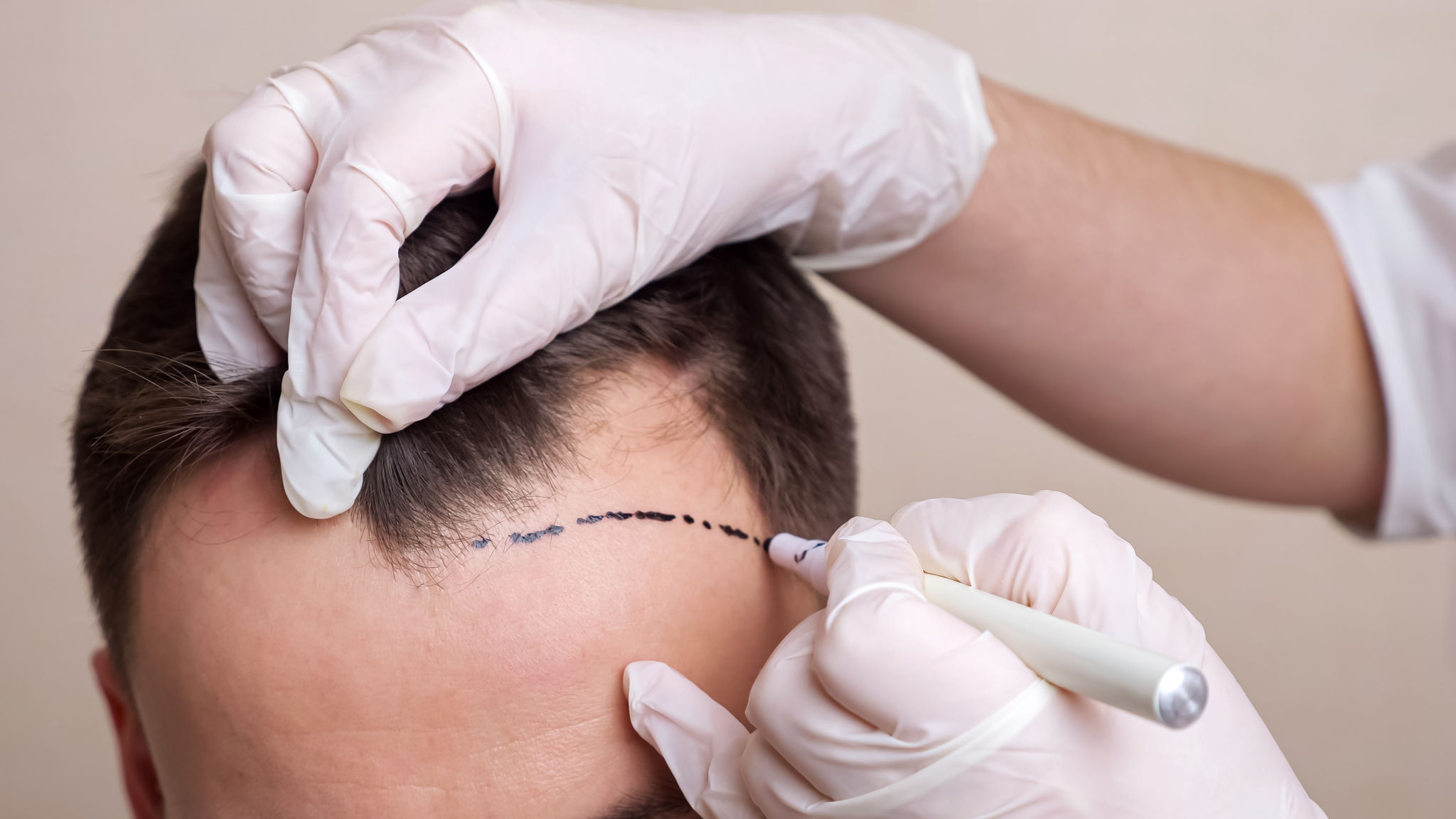 hair surgery