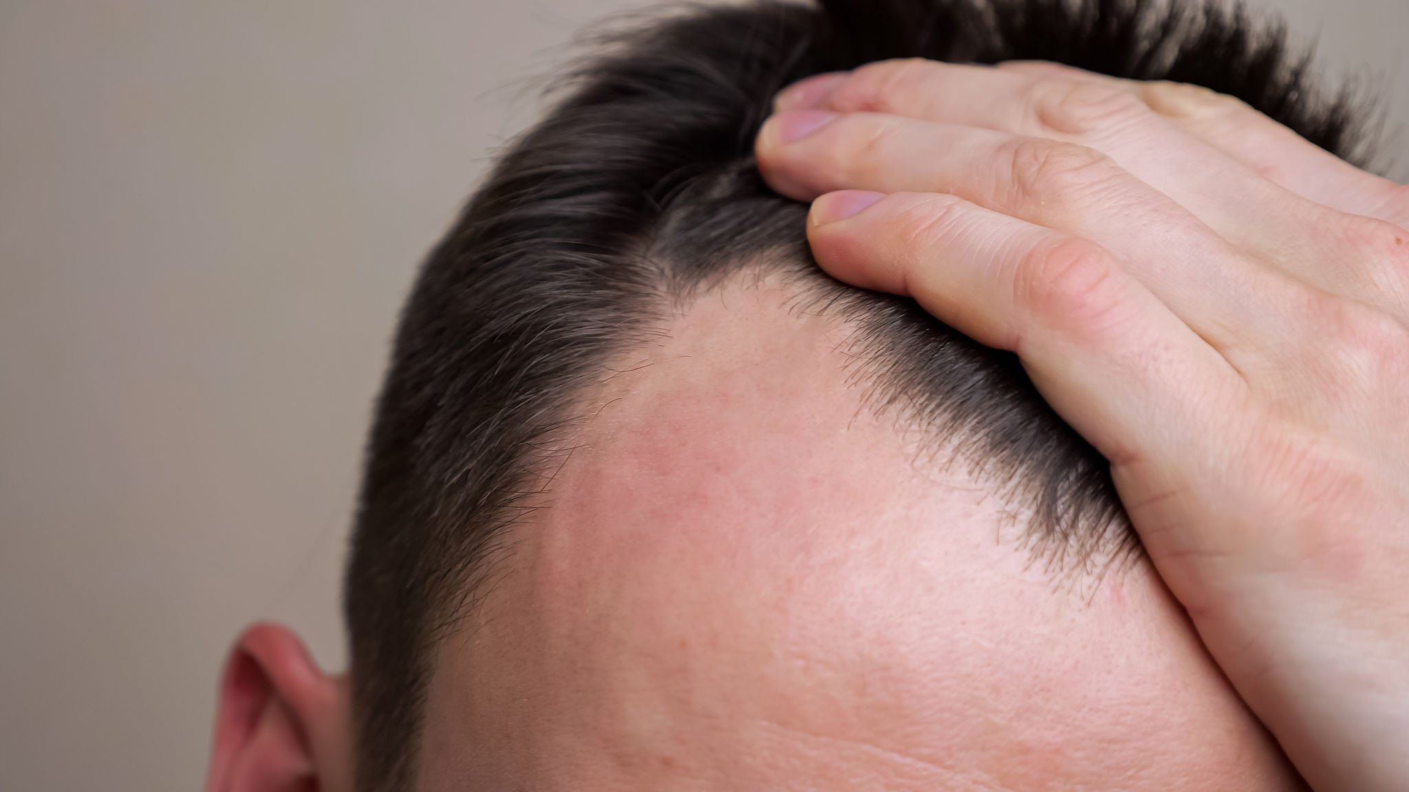 Hair loss leicester prp scalp tension Hair loss leicester prp scalp tension