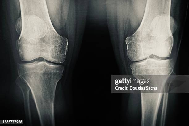 x-ray image of the body - knee surgery stock-fotos und bilder