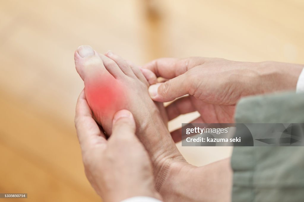 The feet of a man suffering from gout