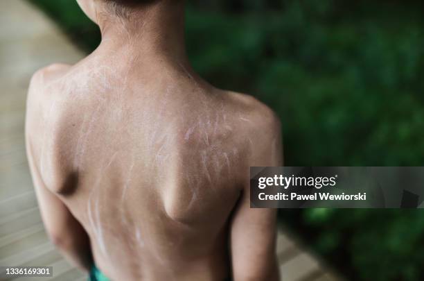 Boy Rash Back Itching Back Photos and Premium High Res Pictures - Getty Images