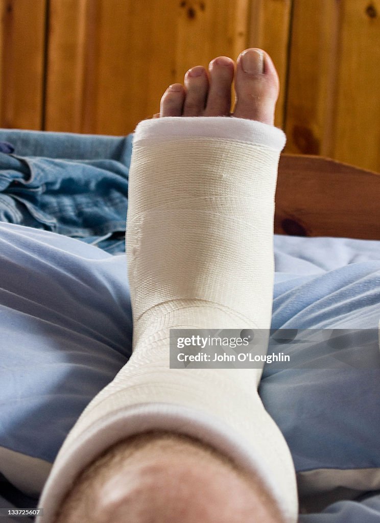 Broken left foot in plaster