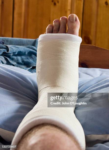 broken left foot in plaster - broken heel stock-fotos und bilder