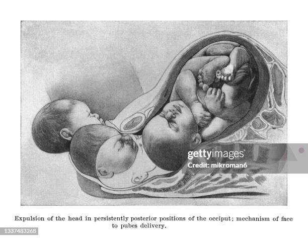 old engraved illustration of expulsion of the head in persistently posterior positions of the occiput - childbirth - position du foetus photos et images de collection