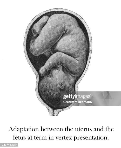 old engraved illustration of adaptation between the uterus and the fetus at term in vertex presentation - fetal presentation stock pictures, royalty-free photos & images