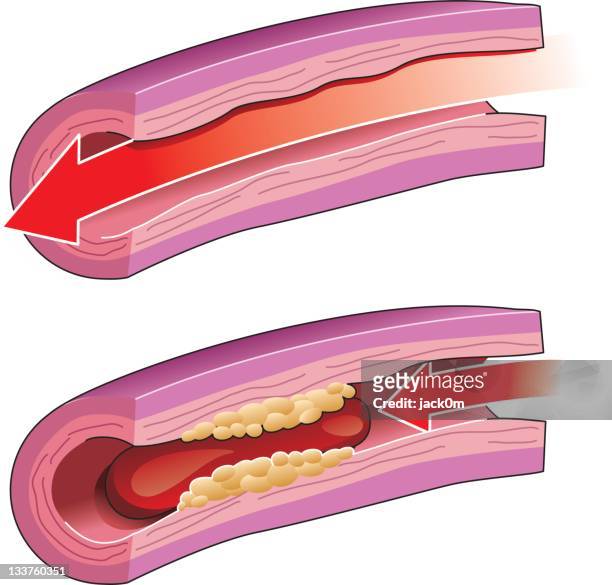 ilustraciones, imágenes clip art, dibujos animados e iconos de stock de trombosis - human artery