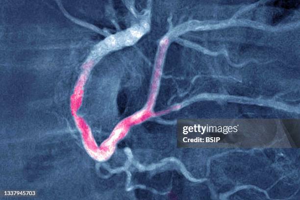 Myocardial infarction with a significant thrombus in the right coronary artery and extends into the left retro ventricular and the posterior...