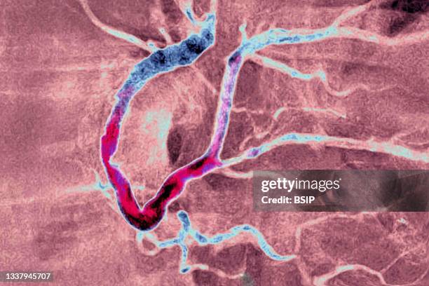 Myocardial infarction with a significant thrombus in the right coronary artery and extends into the left retro ventricular and the posterior...